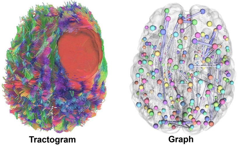 Zwei Gehirne in der medizinischen Bildgebung; einmal als DTI-Aufnahme, daneben...