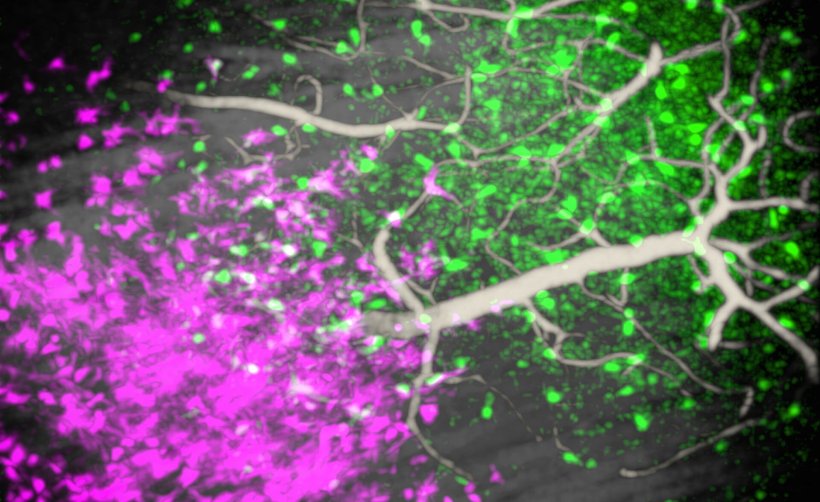 Mikroskopische Aufnahme von Hirntumor- und Immunzellen in Magenta und Grün,...