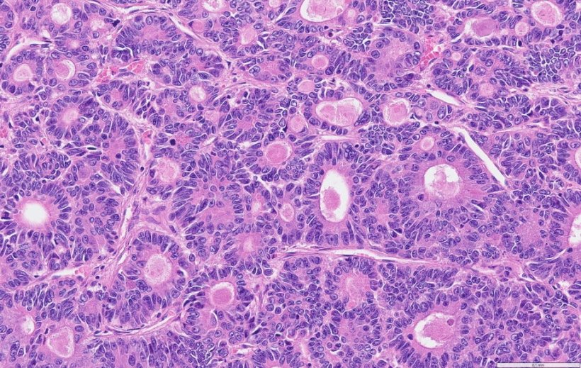 Histological section of colorectal cancer