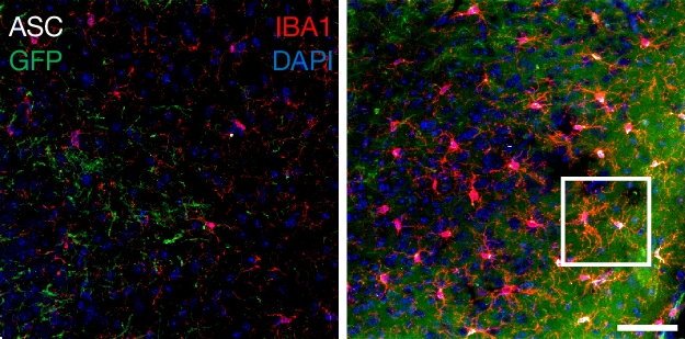 Images of brain tissue showing microglia (Iba1, red), glioblastoma tumor cells...