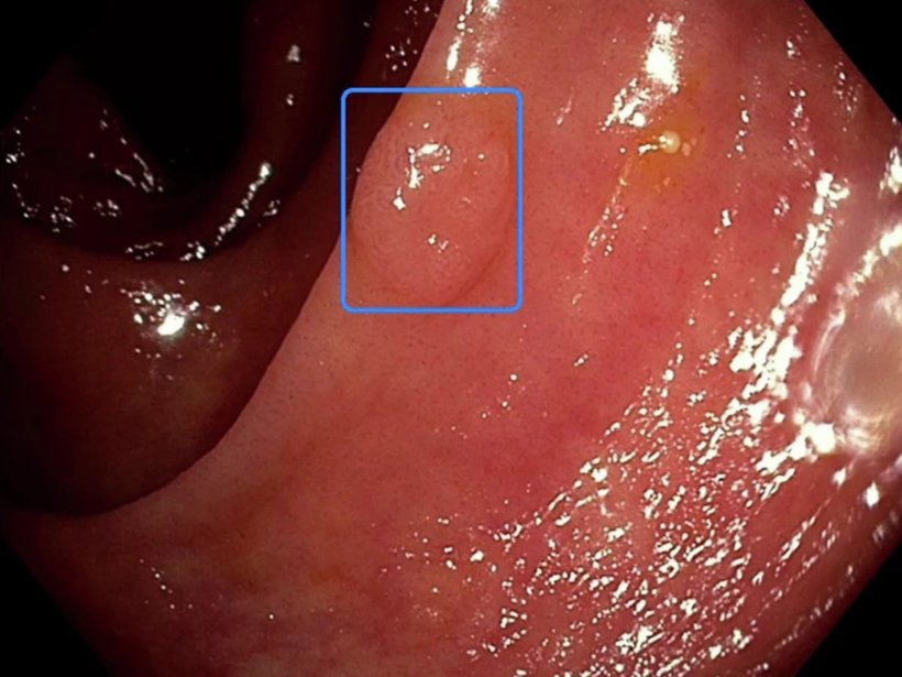 EndoMind ein KI-gestütztes System (Computer-Aided Detection, CADe), das die...