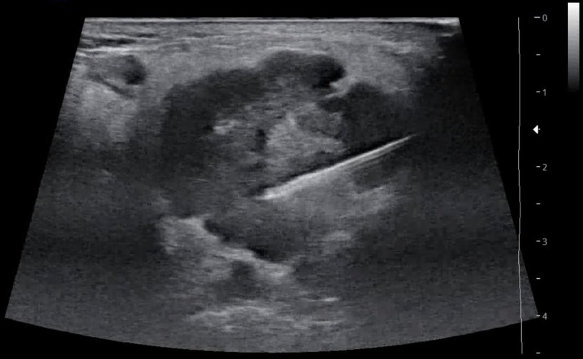 Medical ultrasound image of a parotid gland tumor with a biopsy needle in it