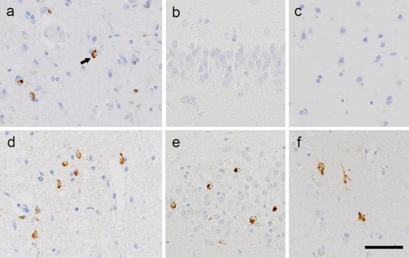 Representative TDP-43 pathology of ALS type 1 and type 2. a—c. Phosphorylated...