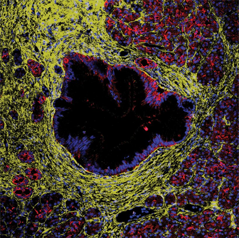 A precursor lesion of pancreatic cancer, shown in immunofluorescence imaging