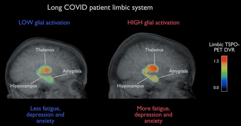 The TSPO-PET image of the brain on the right shows increased glial activation...