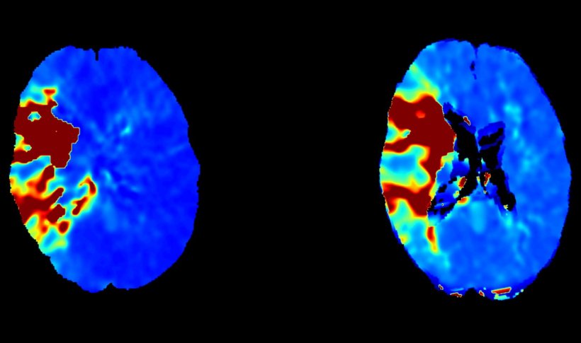 Tmax Perfusionskarten: Links die Cone Beam CT Perfusion, rechts im Vergleich...