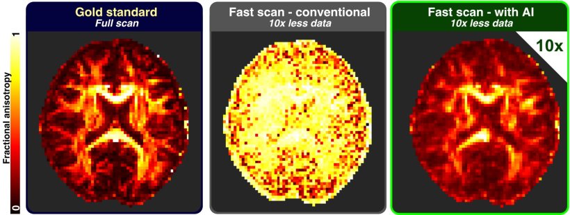 Three MRI scans of a human brain, taken with different protocols, including...