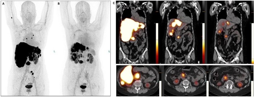 PET/CT images of a patient with neuroendocrine neoplasm with metastases