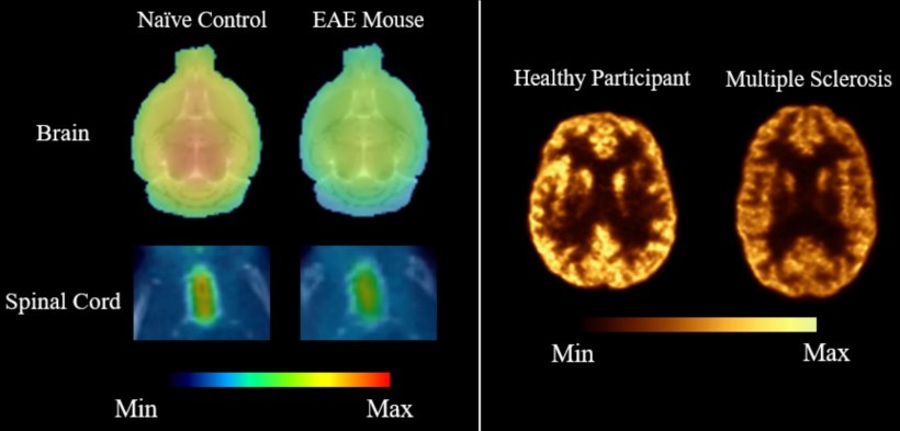Representative SV2A PET images comparing synaptic density in healthy and...