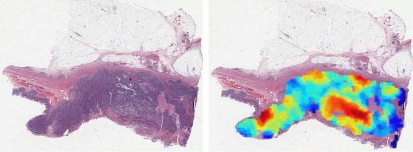 Two pathology tissue samples in H&E staining; the sample on the right includes...