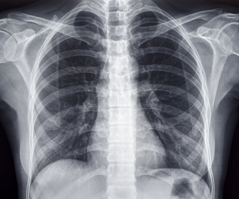 Chest x-ray of an adult female human