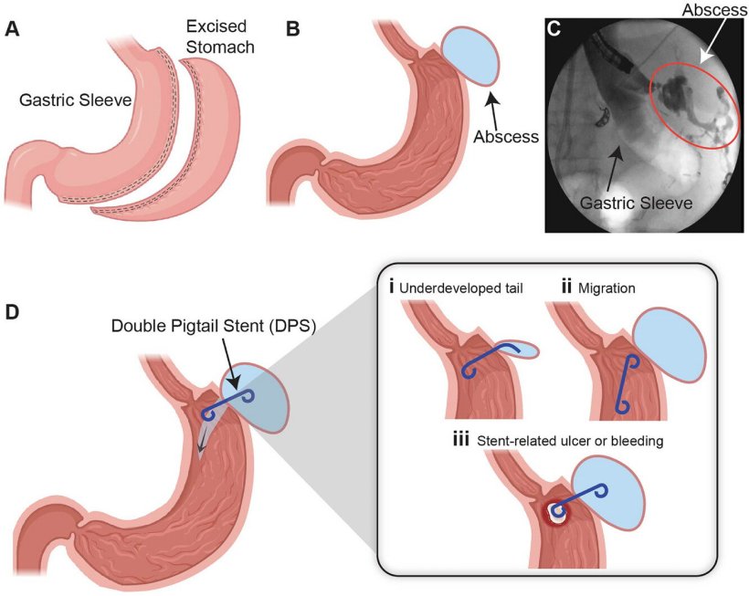 Overview of the surgical procedure. (A) Anatomical illustration of the sleeve...