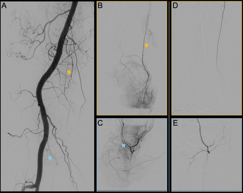 Digital subtraction angiography images of the right knee joint of a 62-year-old...