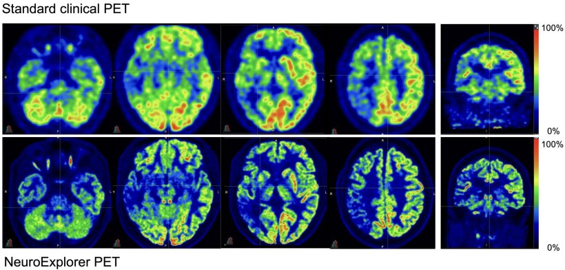 Comparison of normal PET scan (top row) and imaging with the new scanner...