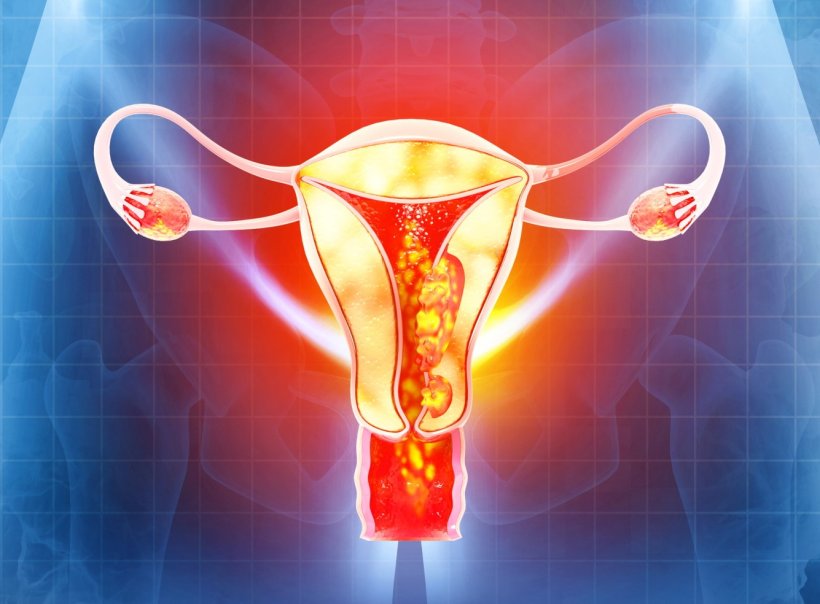 Medizinische Illustration einer Gebärmutter mit Endometriumkarzinom