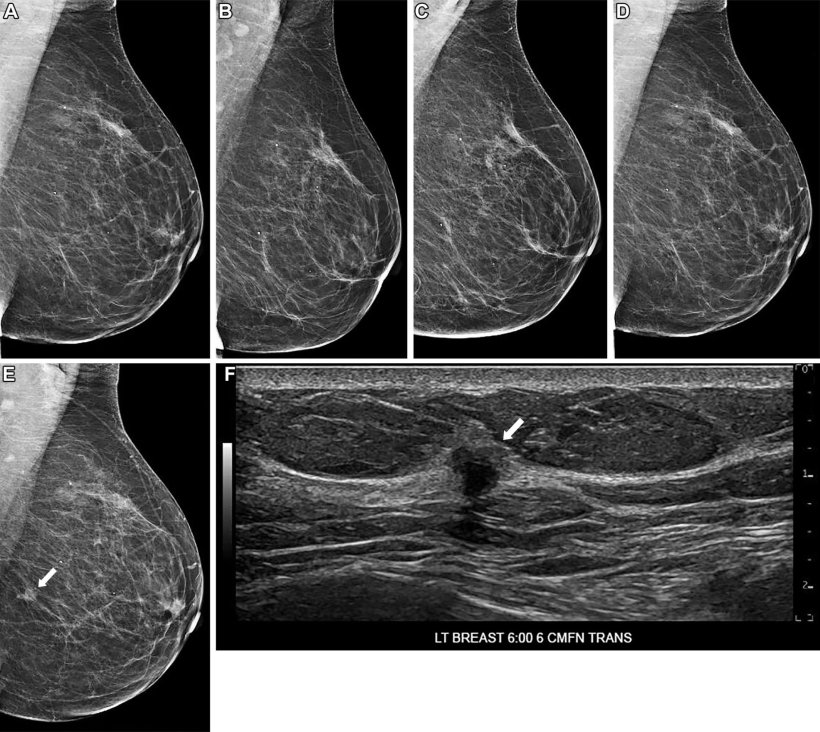 Five mammograms and an ultrasound image of a womans breast