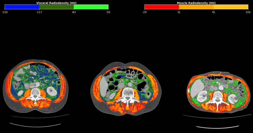 The study developed a marker based on the analysis of routine CT scans of...