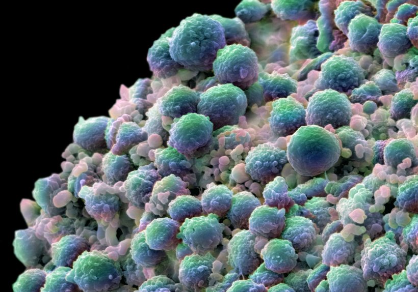 A colorized scanning electron micrograph depicts prostate cancer cells