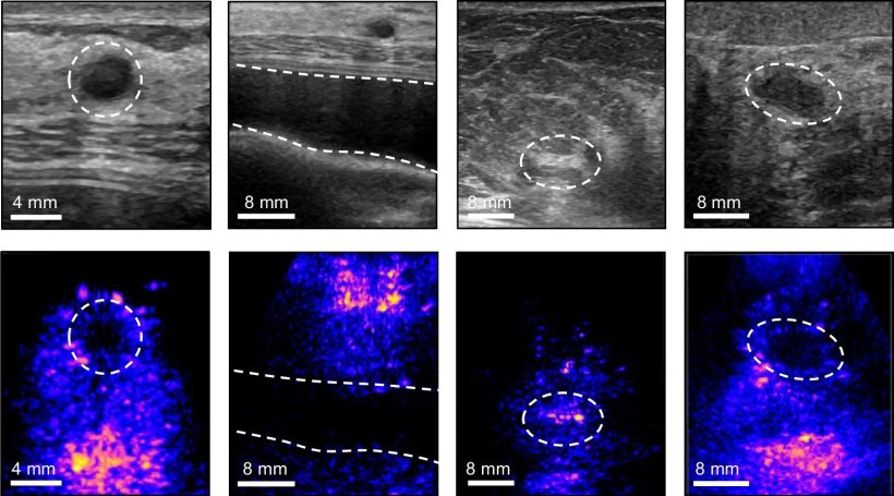 Four views of vivo ultrasound images show, from left to right: a cyst; breast...