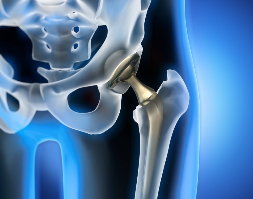 3D illustration of an artificial hip joint in a transparent body model