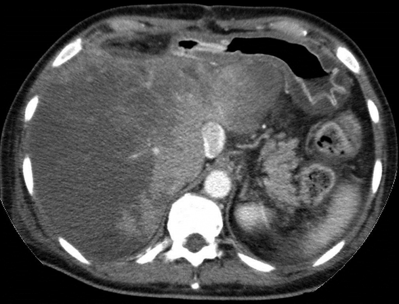 Contrast-enhanced CT of a patient with acute Budd Chiari...
