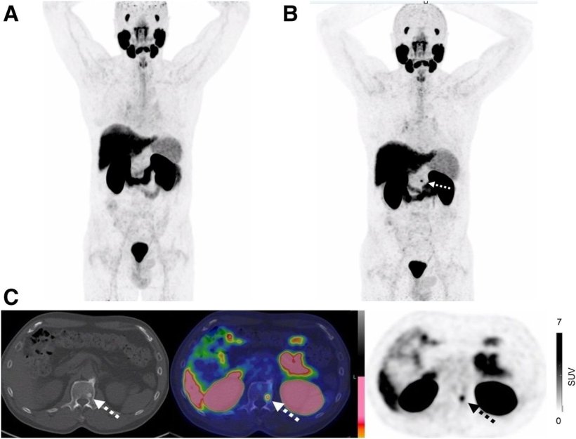 Imaging of 58-year-old man after radical prostatectomy for pT2a pN0 prostate...