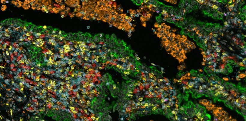 Multiplex-Immunhistochemie der Immunzellen in einem nicht-kleinzelligen...