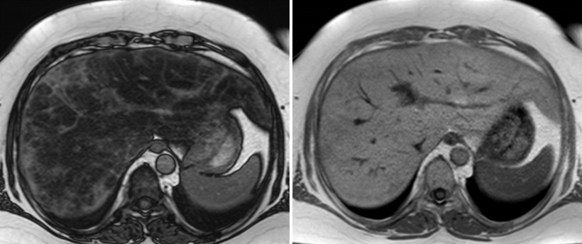 Liver MRI of patient with primary biliary cholangitis (PBC): combination of...