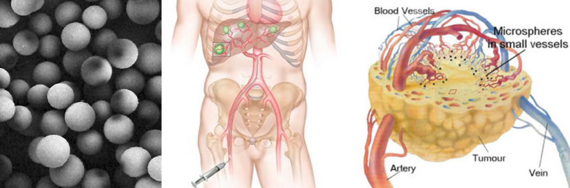 How SIRT works: beta-emitting microspheres are applied through the femoral...