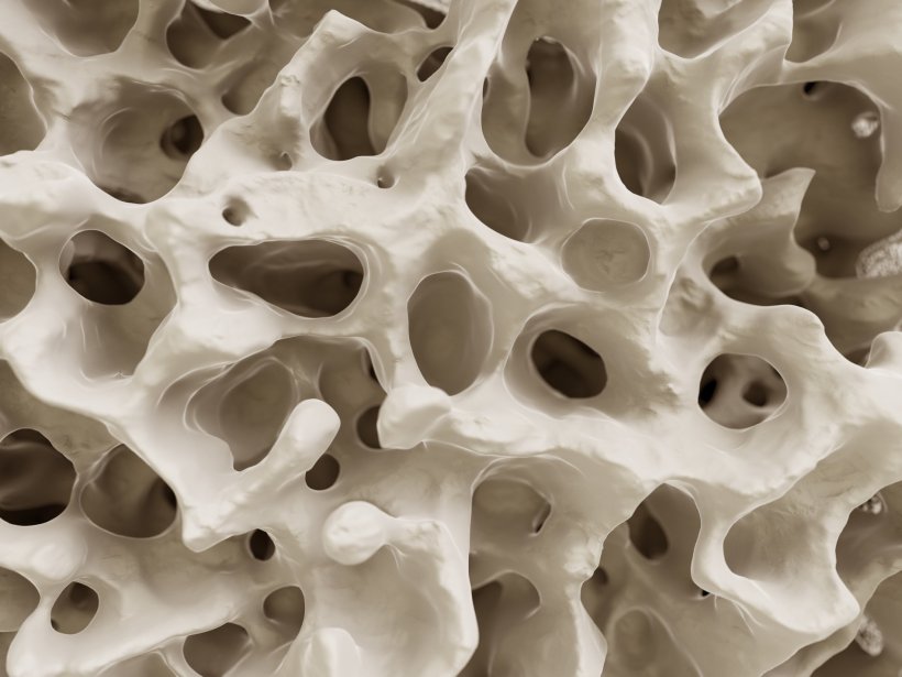 3D-Illustration eines Knochens mit Osteoporose