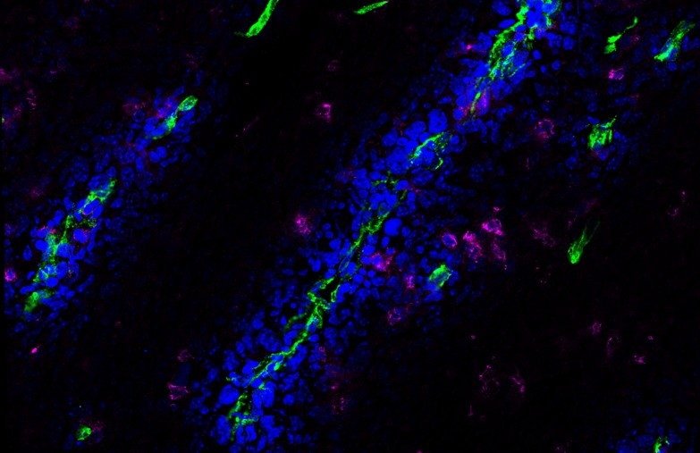 Image of T lymphocytes (purple) located in different tumour microenvironments....