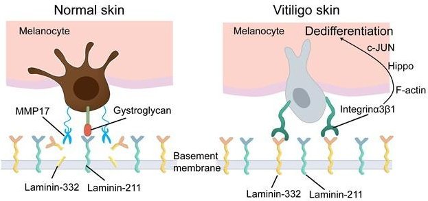 How changes in melanocyte attachment to the extracellular layer drive vitiligo:...