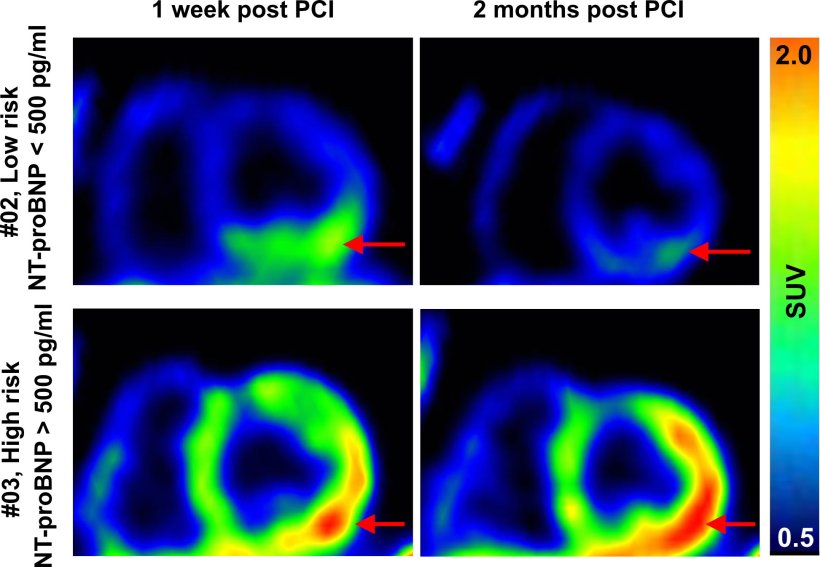 New PET imaging visualises how the heart is healing after a heart attack and is...
