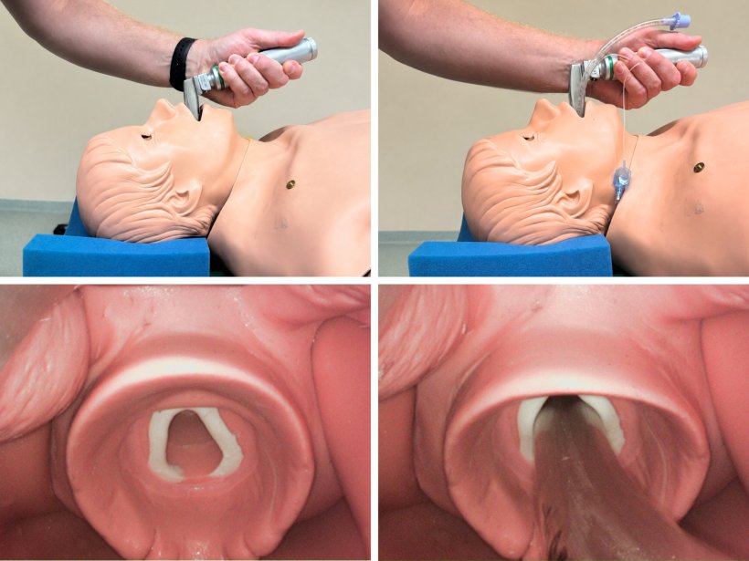 Die Collage demonstriert den Laryngoskopie- und Intubationsvorgang im...