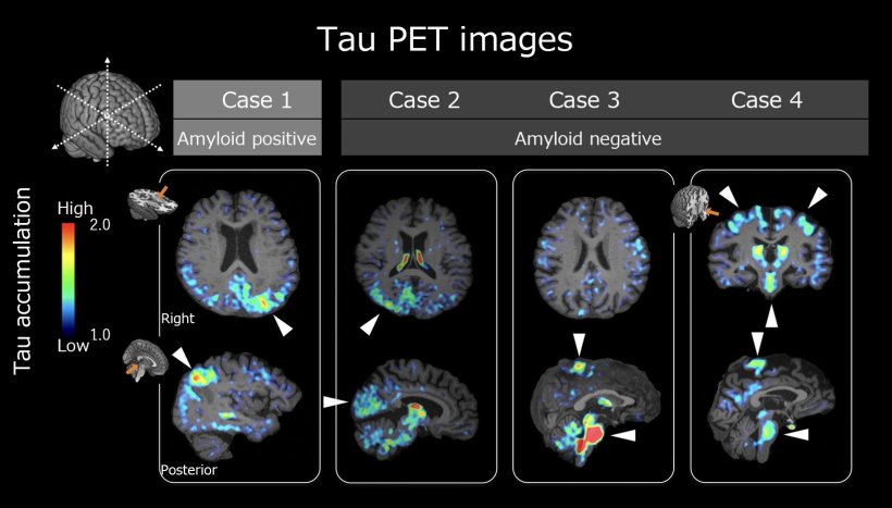 Representative florzolotau (18F) tau PET images from four patients. Case 1...