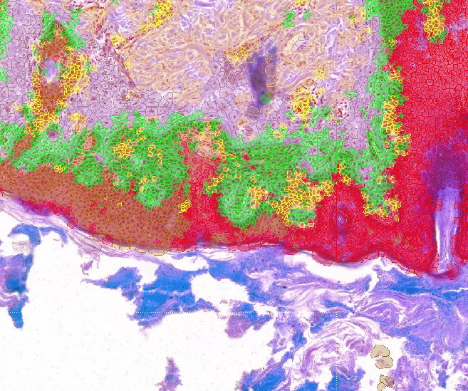 AI-guided single-cell tumor analysis