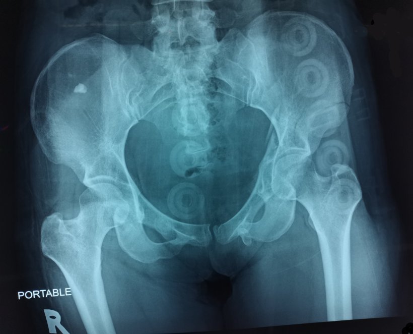 X-ray image of a human pelvis