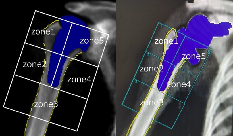 Two x-ray scans of a human shoulder with implant highlighted in blue. In both...
