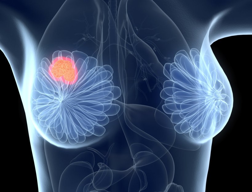 3d illustration of a transparent torso of a woman, with breast cancer...