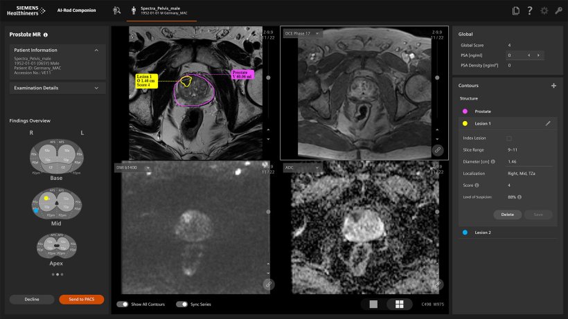 AI-Rad Companion Prostate MR automatically detects and segments suspicious...