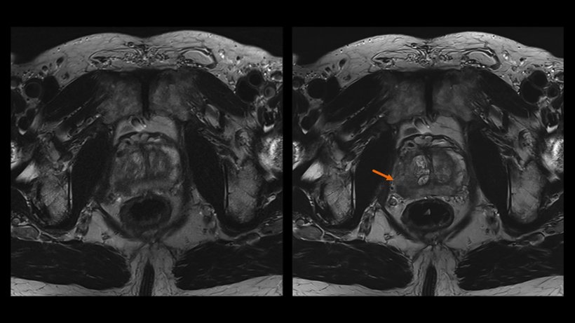 Improved quality of prostate TSE acquisition and the lesion visualization with...