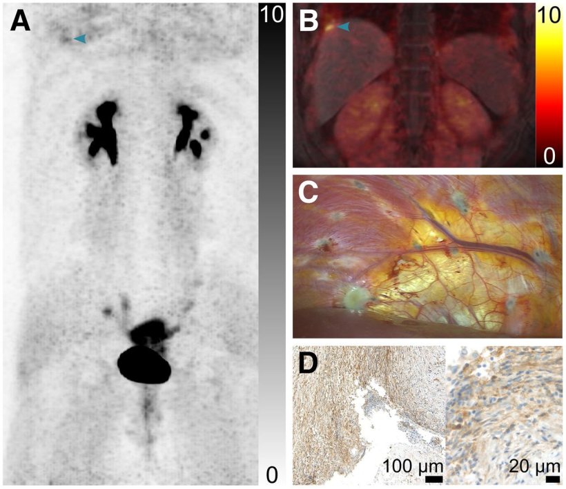 Images from patient T1, who had menstrual cycle–dependent right shoulder...