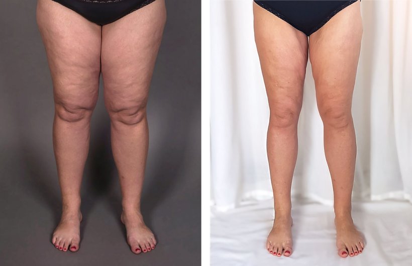 Zwei Fotos von Beinen einer Patientin mit Lipödem, links vor der Liposuktion,...