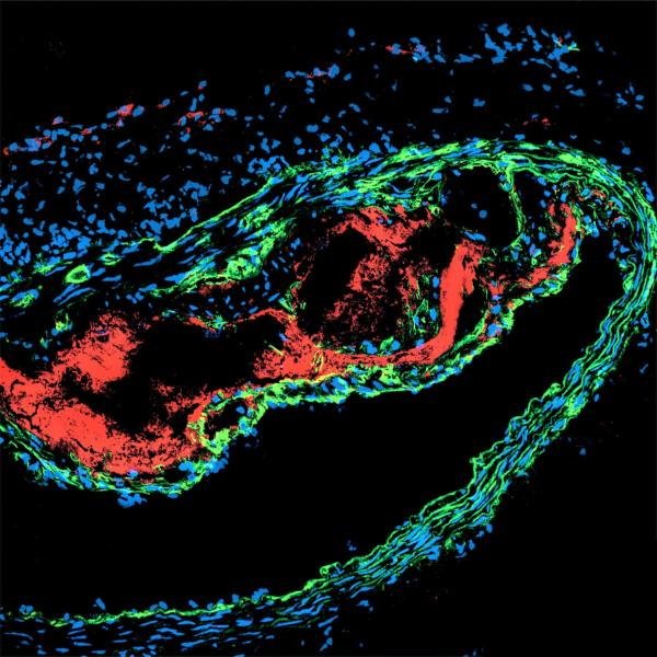 Autoantikörper richten sich gegen die erkrankte Arterienwand mit...