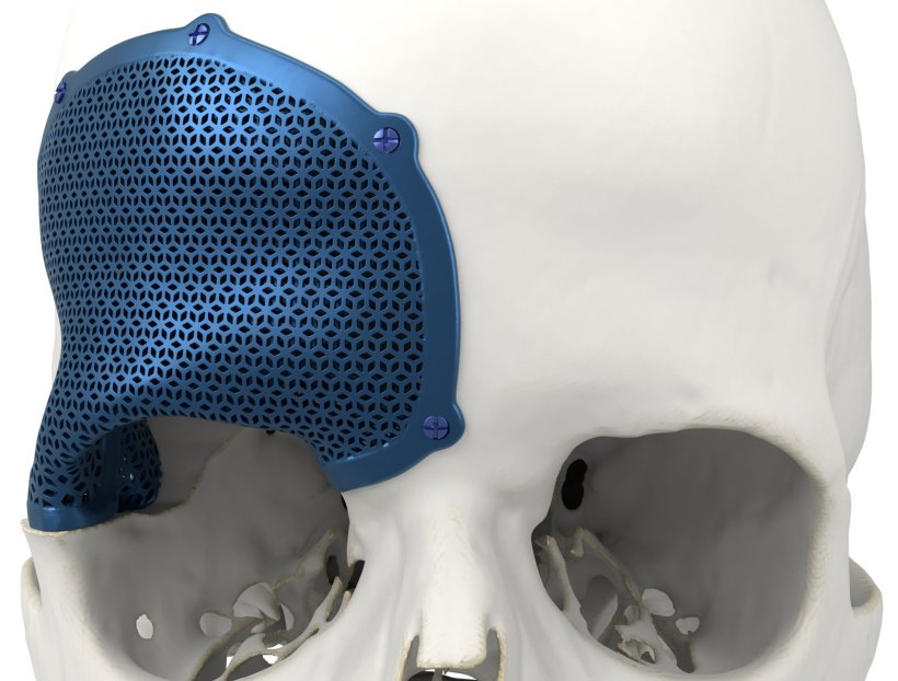 Closeup rendering of a 3D-printed skull implant