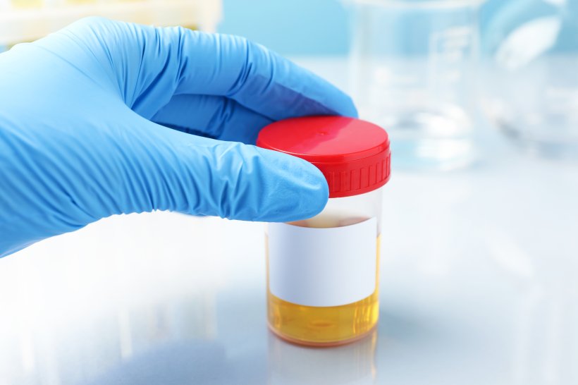 Urine test detects 9 in 10 bladder cancers in NHS study