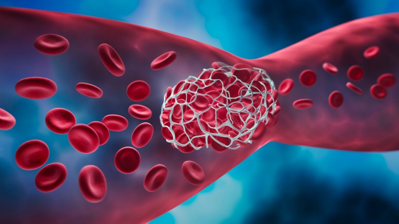 Darstellung einer Thrombose