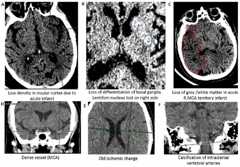 A-E show examples of various subtle stroke signs. F shows normal calcification...