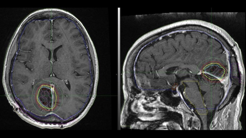 Image of tile-based radiation location in tumor brain cavity