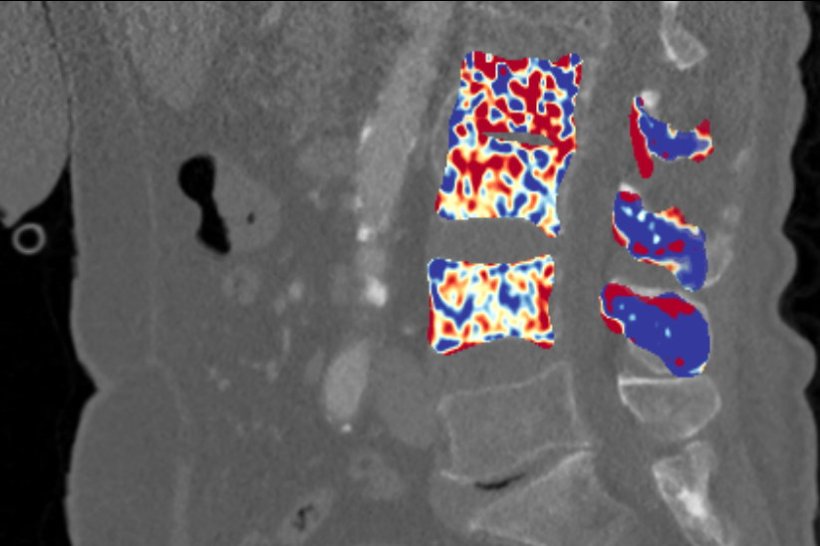 CT-Aufnahme einer Wirbelsäule mit farbiger Hervorhebung der Knochendichte bei...